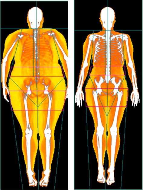 DEXA Scans with Body Map 360